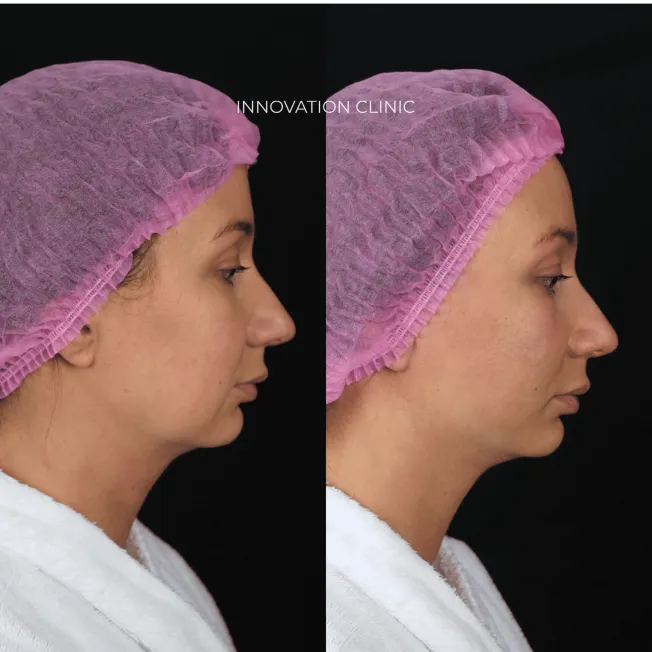 Лифтинг нижней трети лица нитями Aptos  