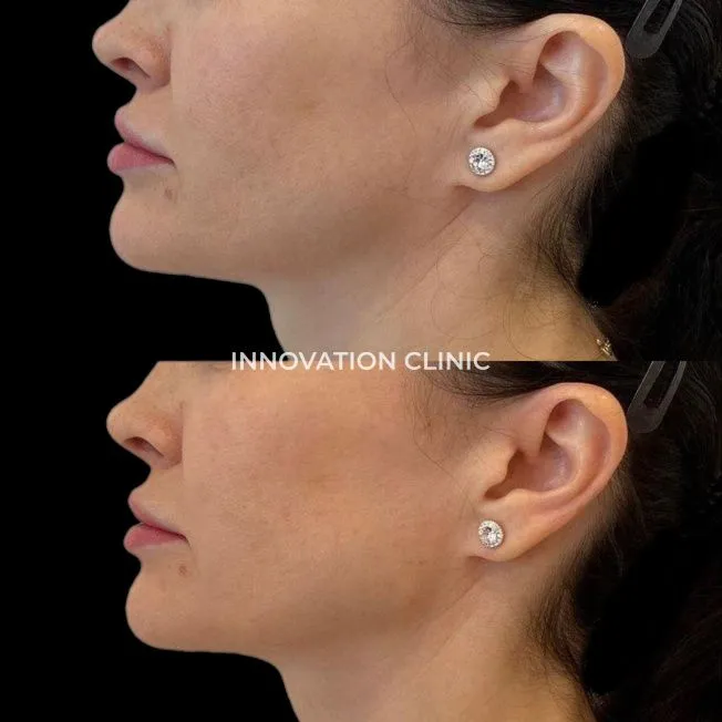 Коррекция нижней трети лица фото до и после 3