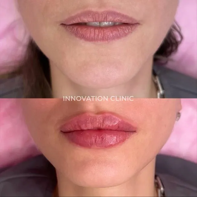 Коррекция формы губ филлером фото до и после 8