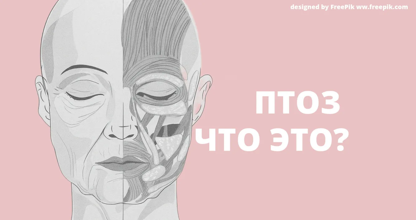 Птоз лица
