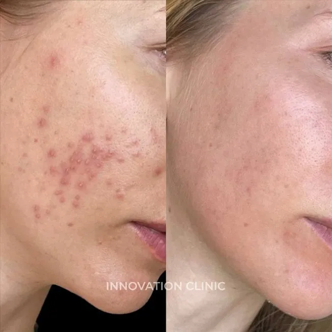Комплексное лечение акне фото до и после 6
