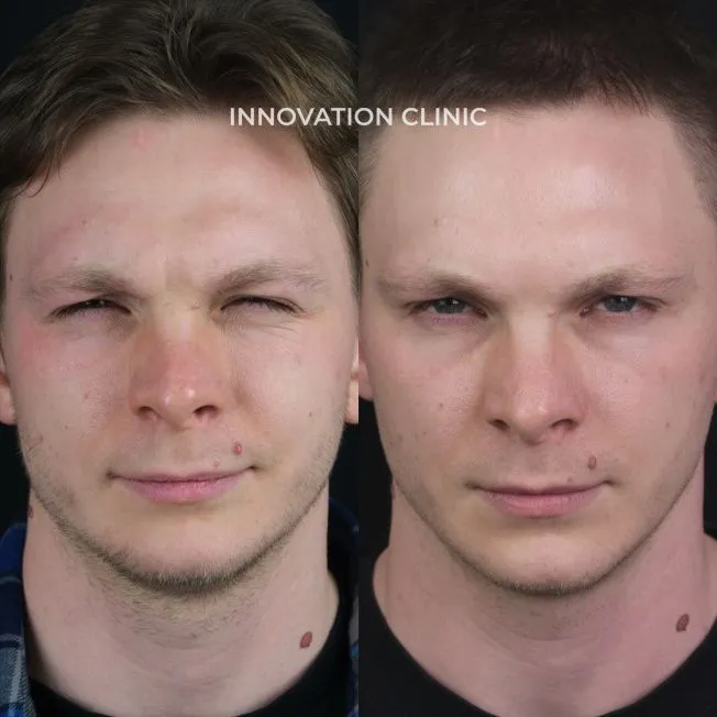 Коррекция мимических морщин лба фото до и после 9