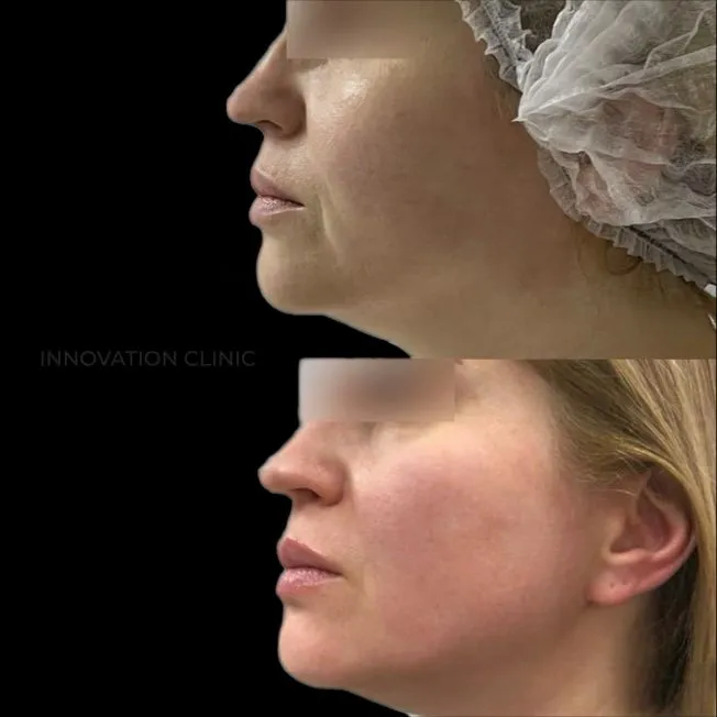 УЗ SMAS-лифтинг нижней трети лица фото до и после 1