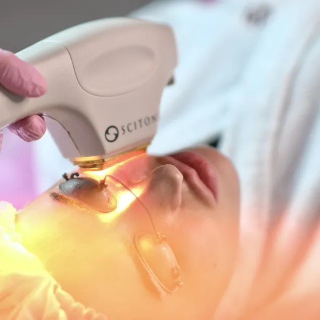 Удаление купероза лазером