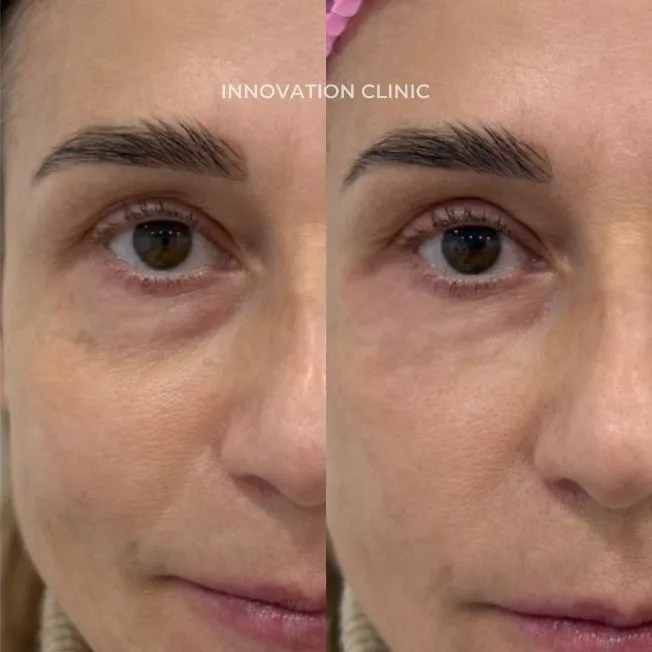 Коррекция носослёзной борозды фото до и после 12