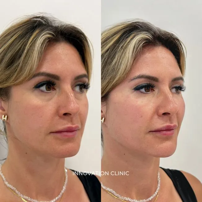 Деликатная FullFace-коррекция лица фото до и после 3