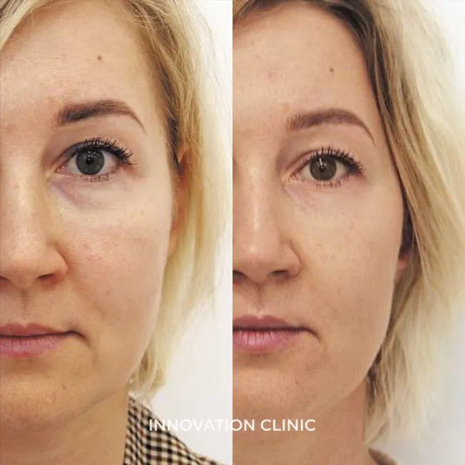 Микроигольчатый RF-лифтинг лица фото до и после 2