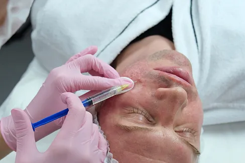 Мезотерапия для мужчин