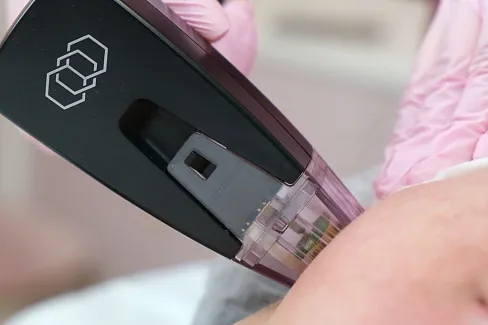 Процедура Морфеус для омоложения