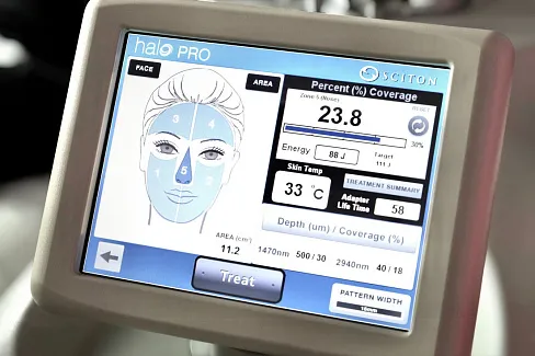 Фракционное лазерное омоложение лица на аппарате Фраксель