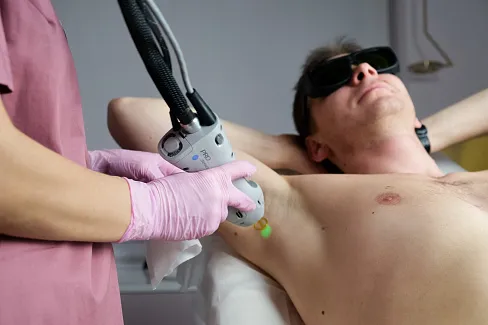 Процедура лазерной эпиляции Candela