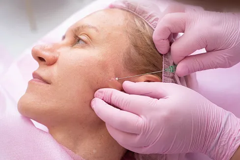 Лифтинг при помощи нитей Аптос