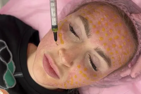 Очищение пор пилингом