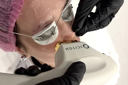 Удаление сосудистых звездочек на лице у врача-косметолога