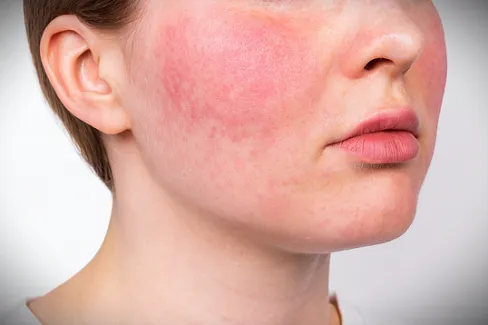 Безопасное лечение розацеа лазером