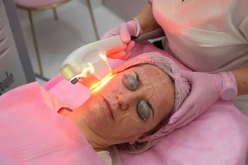 Фотоомоложение BBL длится 60 минут