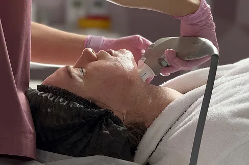 После СМАС-лифтинга Ультраформер 3 сокращаются морщины