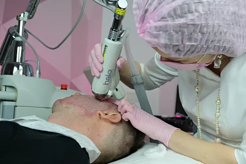 Подготовка к лазерному удалению растяжек