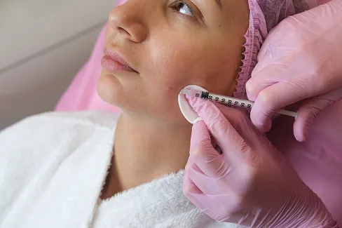 Процедура удаления папиллом лазером