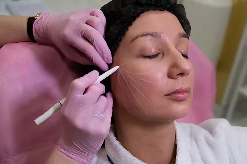 Безболезненный векторный лифтинг Радиесс