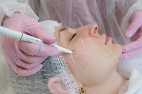 Нитевой лифтинг корректирует асимметрию