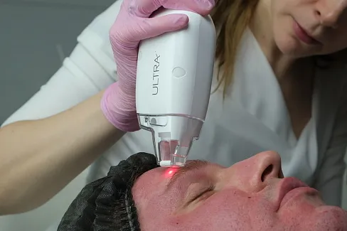 Лазер Lase MD Ultra при выпадении волос