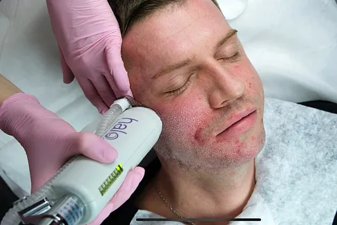 Фракционный лазер для омоложения лица