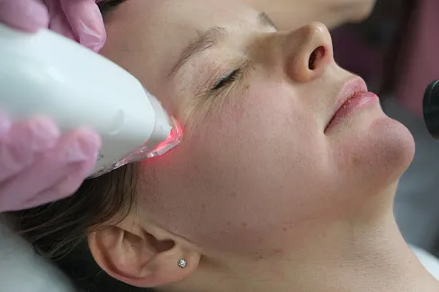 Лазерная косметология лечит постакне