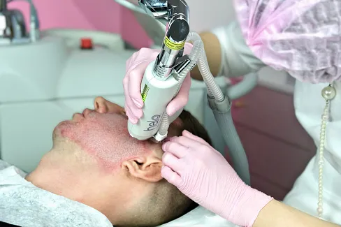 Лазерная шлифовка HALO при растяжках