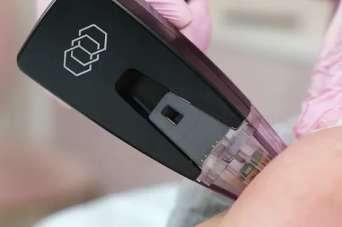 Игольчатый РФ-лифтинг в зоне живота