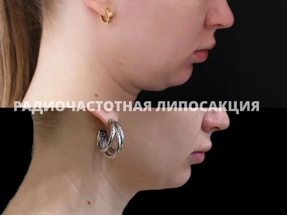 Коррекция субментальной области с помощью радиочастотной липосакции FaceTite, 1 процедура. Врач: Артавазд Чопикян