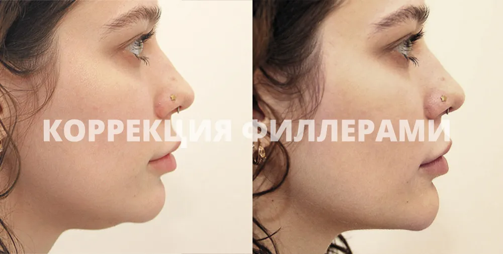 Коррекция подбородка филлерами. Врач: Артавазд Чопикян