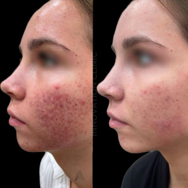 Комплексное лечение акне фото до и после 15