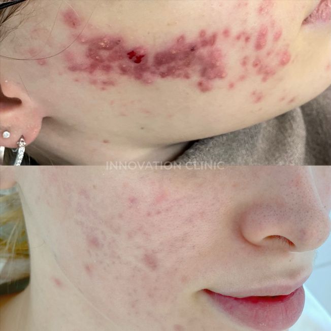 Комплексное лечение акне фото до и после 3