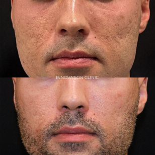 Лазерная шлифовка рубцов от акне фото до и после