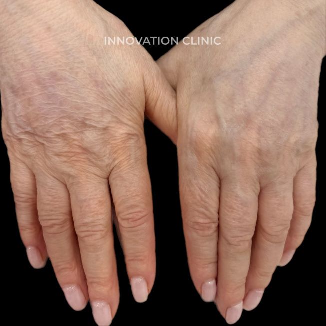 Монополярный RF-лифтинг Volnewmer фото до и после 7