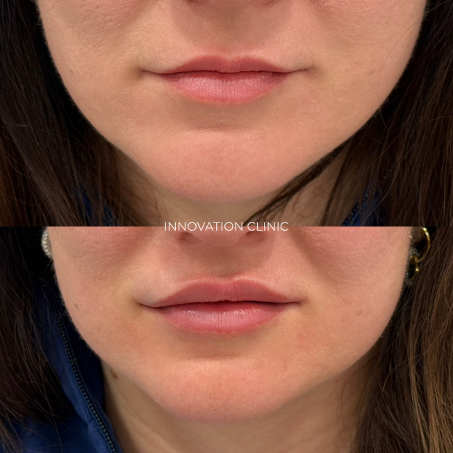 Коррекция формы губ