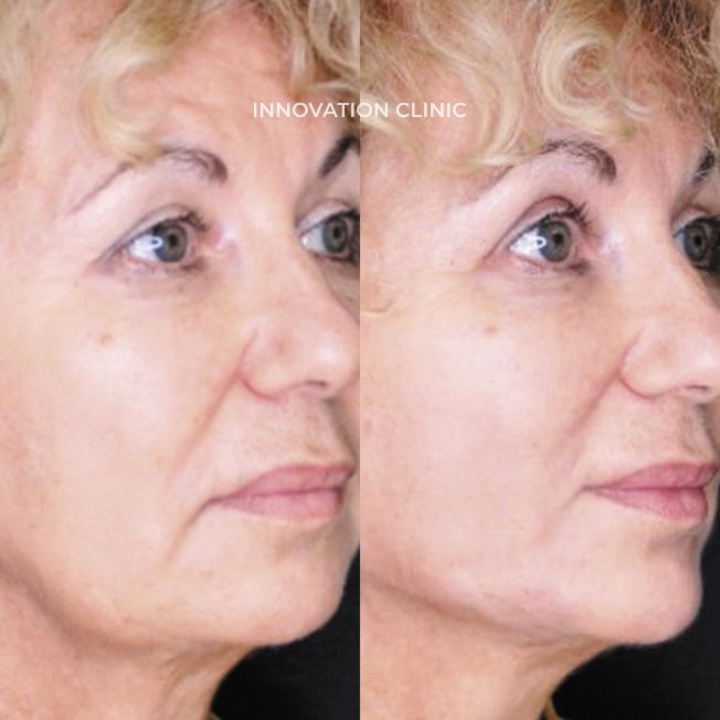 Нитевой лифтинг лица фото до и после 9