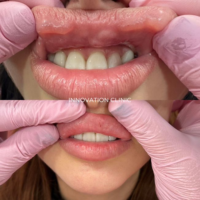 Удаление гиалуронового филлера из губ фото до и после 2