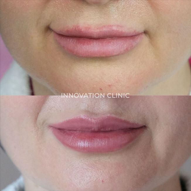 Коррекция формы губ филлером фото до и после 18