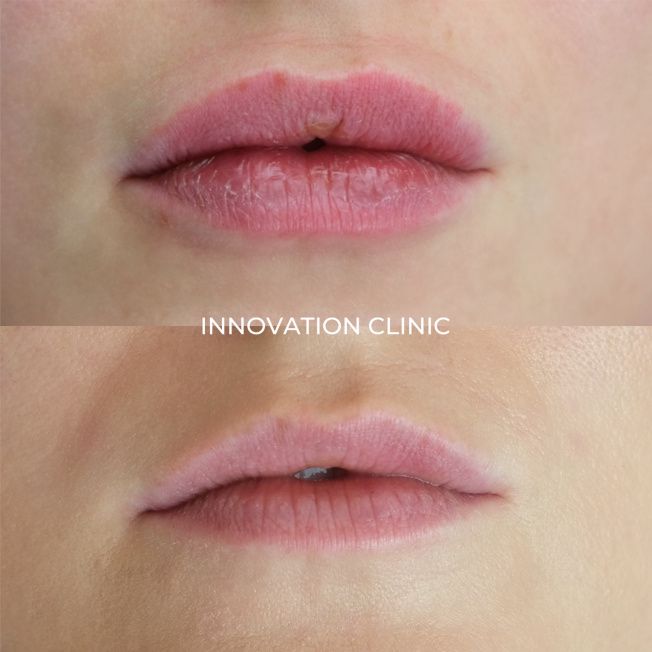 Удаление гиалуронового филлера из губ фото до и после 1