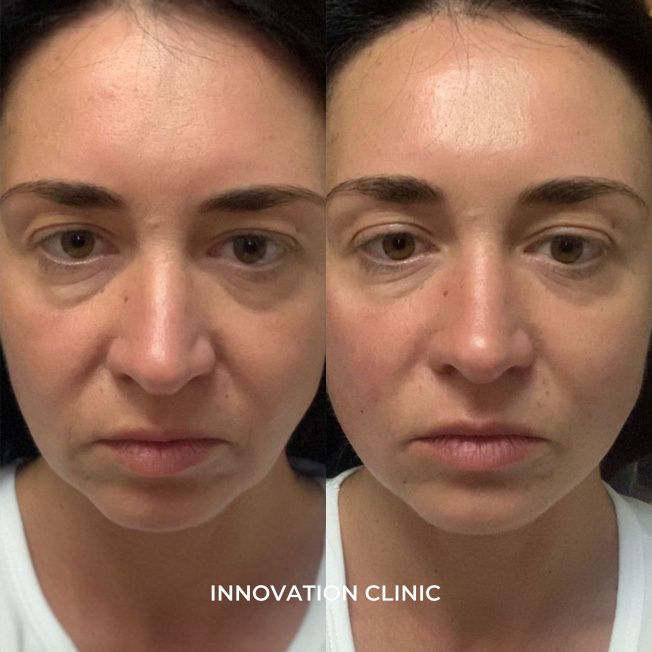 Деликатная гармонизация лица филлером фото до и после