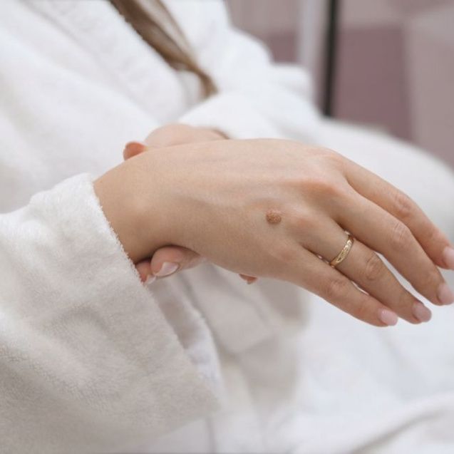 Удаление бородавок