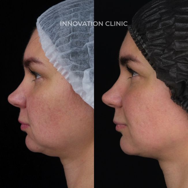 Монополярный RF-лифтинг Volnewmer фото до и после 3