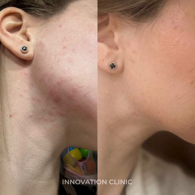 Комплексное лечение акне фото до и после 14