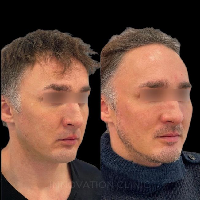 Нитевой лифтинг лица фото до и после 12