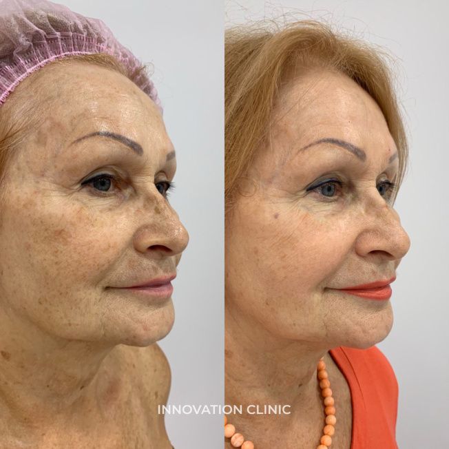 Лазерная шлифовка лица фото до и после 2