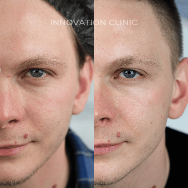 Коррекция мимических морщин лба фото до и после 7