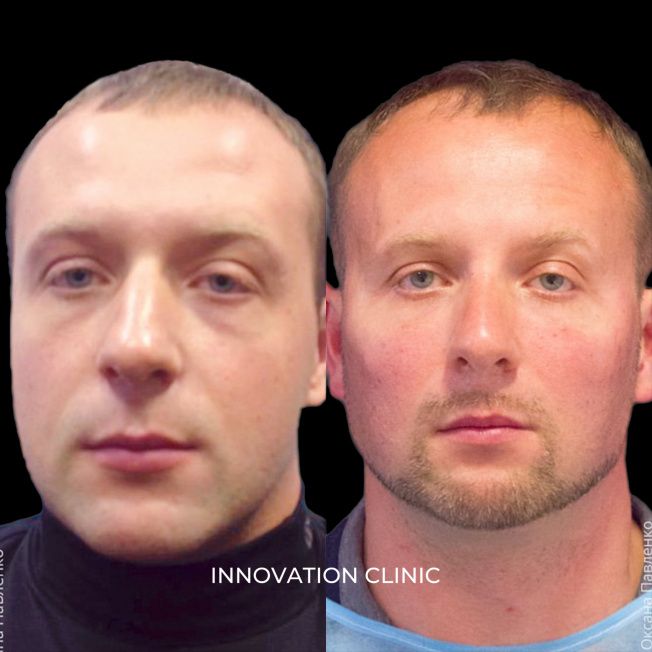 FullFace-коррекция лица филлерами фото до и после 6