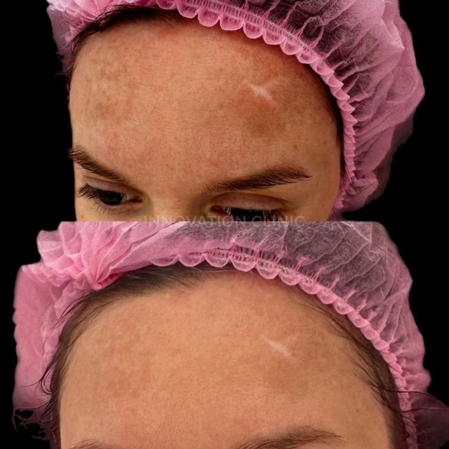 Лечение пигментации фото до и после 1